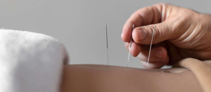 dry needling near me
